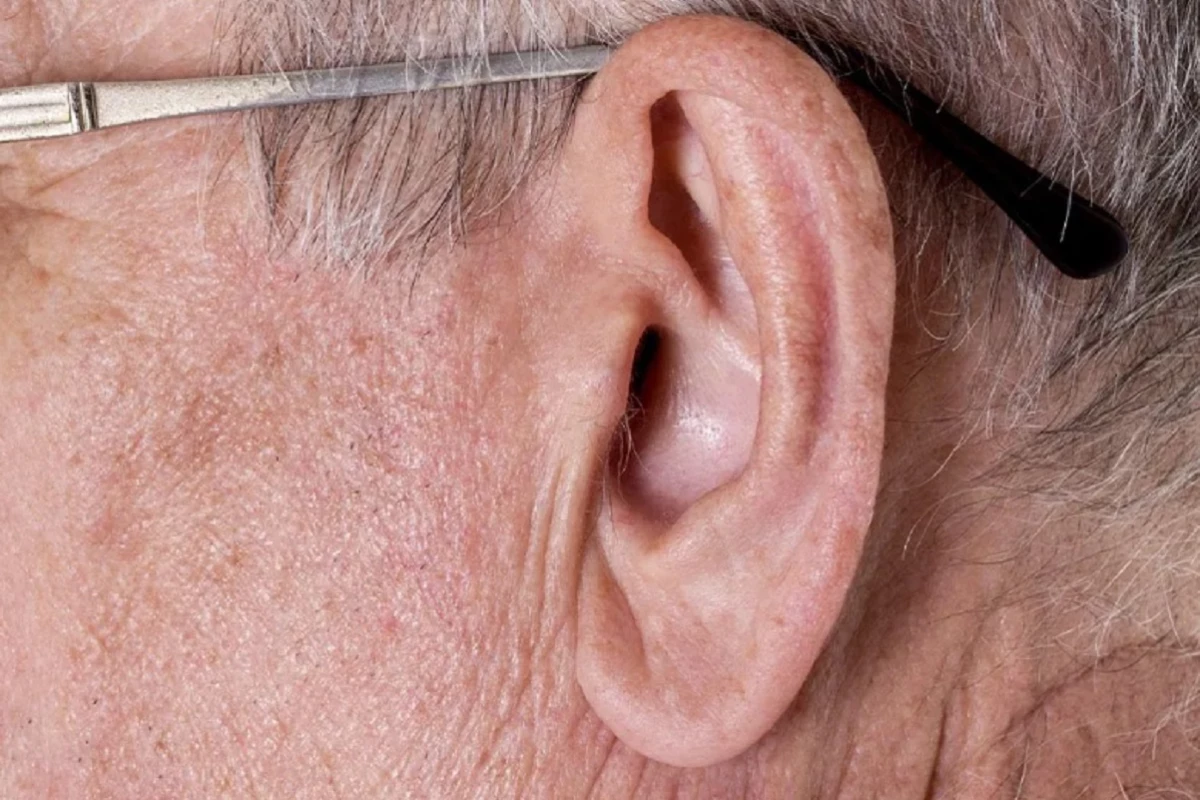 Sinal de Frank: se você tem esse sinal na orelha precisa ficar atento e buscar avaliação médica urgente